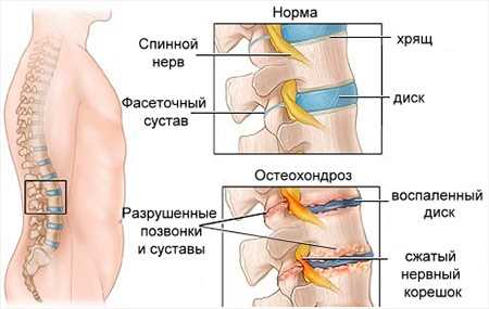 Замучив радикуліт? Поради по лікуванню в домашніх умовах