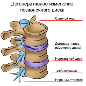 Коли необхідно медикаментозне лікування радикуліту і як його починати